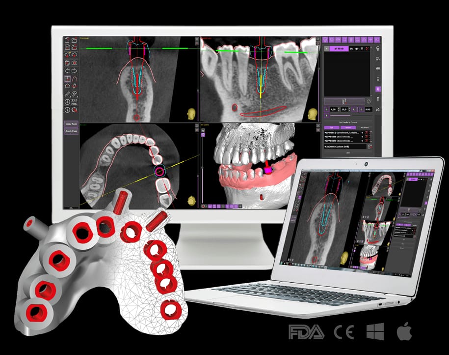 השתלה מונחית מחשב (Computer-Assisted Implant Surgery)